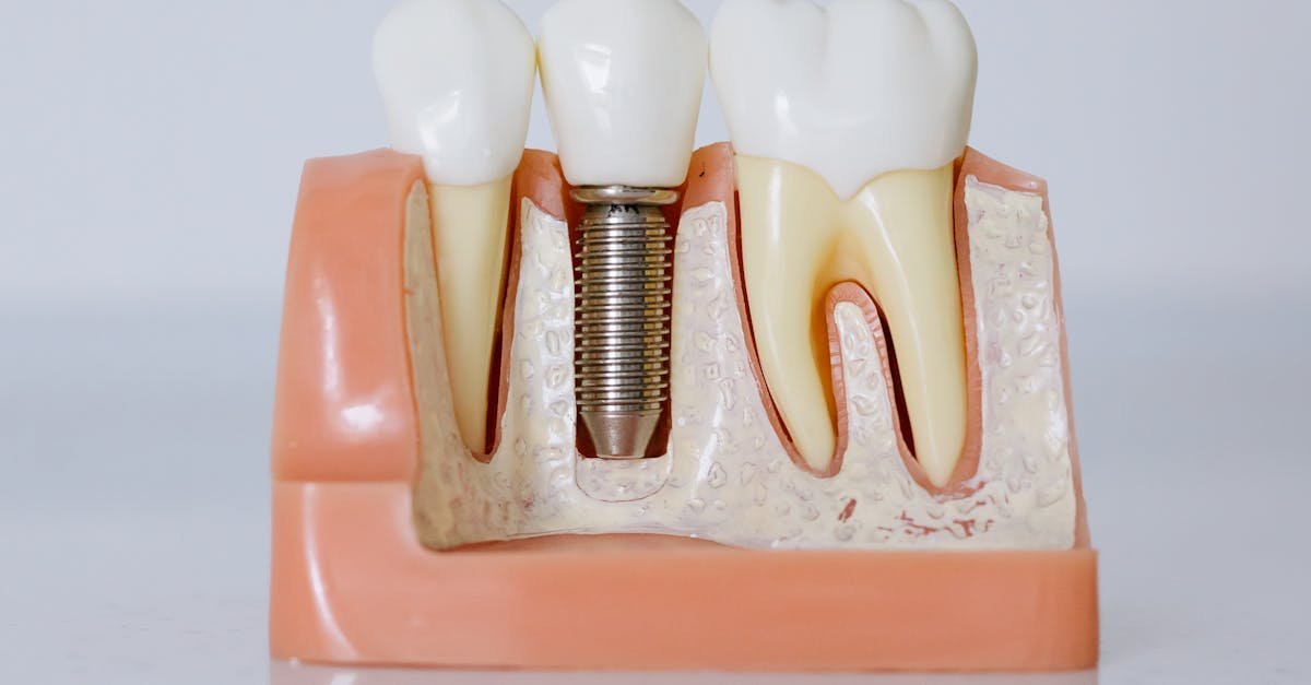 Detailed view of a dental implant model showcasing teeth and gum anatomy for dental education.